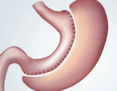 Manga Gastrica